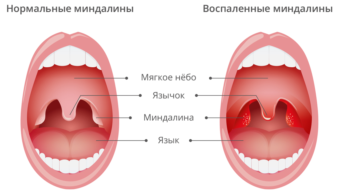 Налет на миндалинах